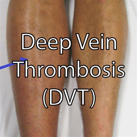 Deep Vein Thrombosis Dvt Medical Notes Yardcard