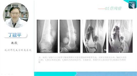 骨肿瘤专家亲授：《部位骨肿瘤与肿瘤样病变的影像诊断与鉴别》腾讯视频