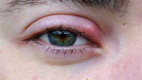 Swollen Eyelid and Pain: Causes, Treatment, and Prevention - Swollen Eyelid