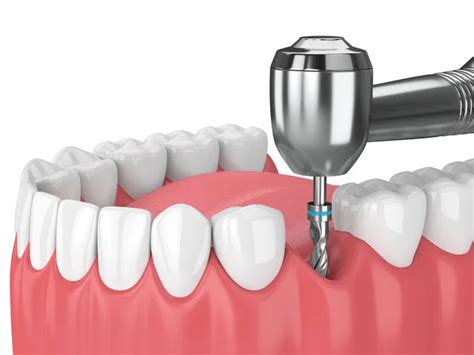 3d Render Of Jaw With Implants And Orthodontic Braces Stock Photo By