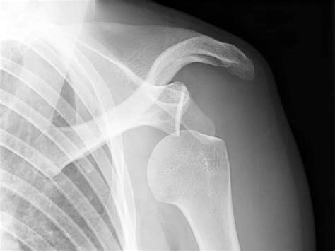 Mri Shoulder Dislocation