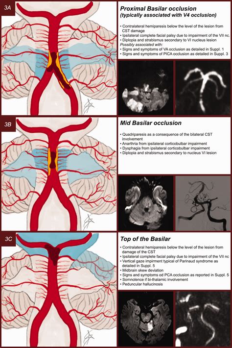 Posterior Cerebral Artery Stroke