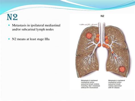 Ppt Lung Cancer Staging Powerpoint Presentation Free Download Id4678509