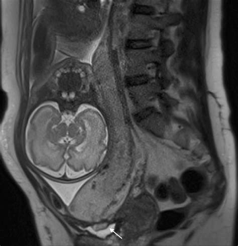 A 30 Year Old Patient With Total Placenta Previa Sagittal T2 Weighted Download Scientific