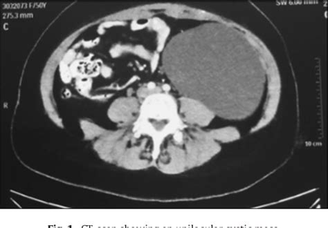 Figure 1 From Primary Retroperitoneal Mucinous Cystadenoma Semantic