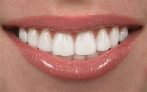 Composite Veneers Pros And Cons