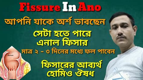 Fissure এনল ফসরর হমও চকৎস Fissure Homeopathiic Medicine Anal Fissure Homeopathy