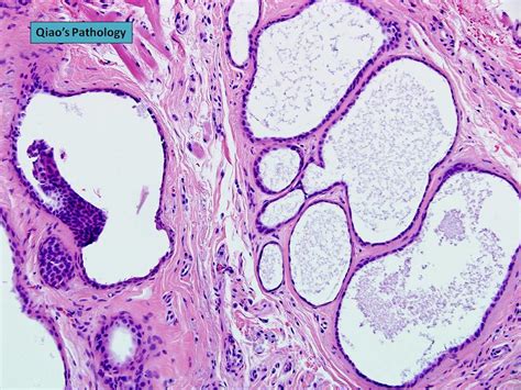 Flickriver Photoset Apocrine Hidrocystoma Molls Gland Cyst Of The