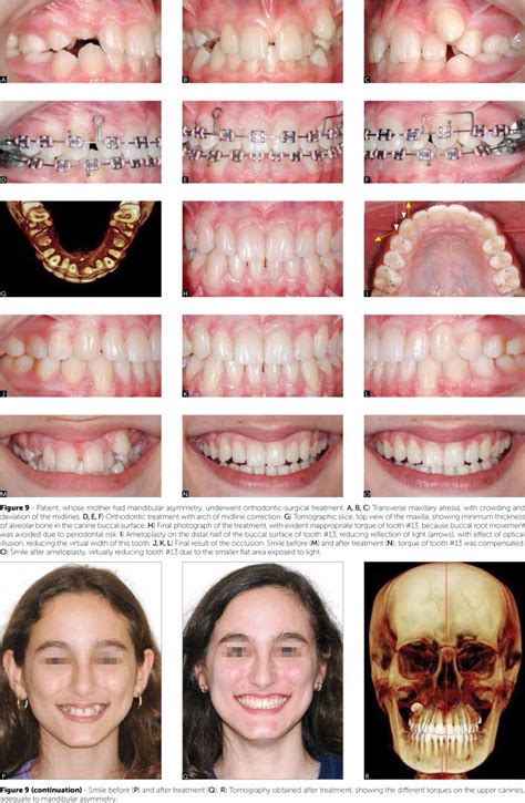 Scielo Brasil Finishing Procedures In Orthodontics Dental