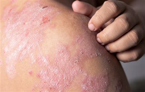 Dermatitis Estos Son Los Factores De Riesgo Y Recomendaciones