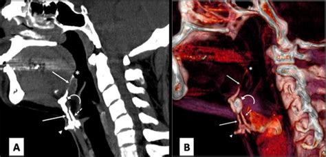 Computed Tomography Fistulography Demonstrating Thyroglossal Fistula A