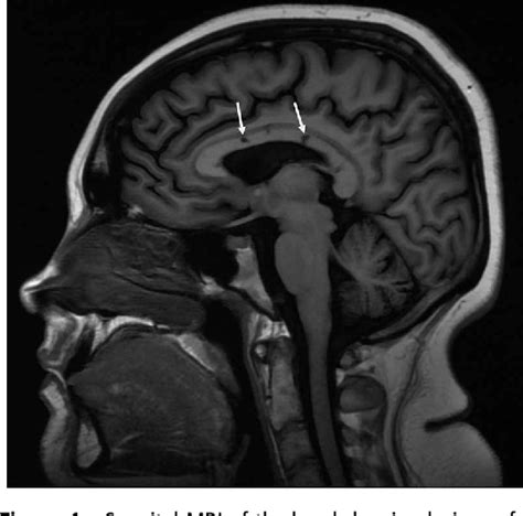 Figure From Susac S Syndrome The Value Of Fundus Fluorescein