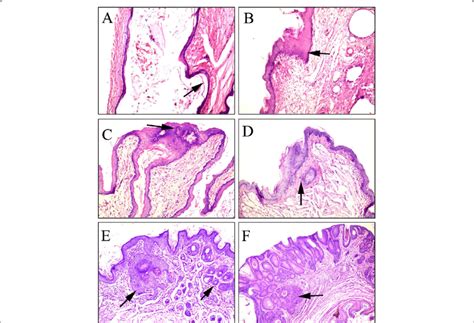 A Photomicrograph Showing Induced Carcinogenesis During Treatment With