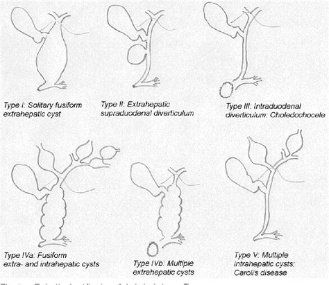 Choledochocele Types