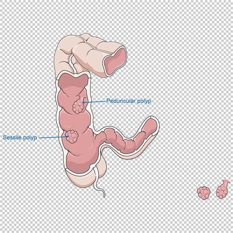 Intestine Colon Polyps Vector