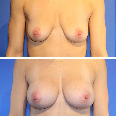 Breast Augmentation Gallery Dr Jeffrey Lisiecki