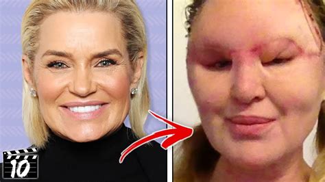 Top Celebrities Who Destroyed Their Faces With Filler Youtube