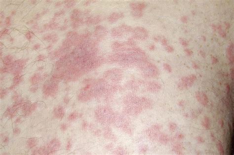 Rash Caused By Tonsillitis Photograph By Dr P Marazziscience Photo