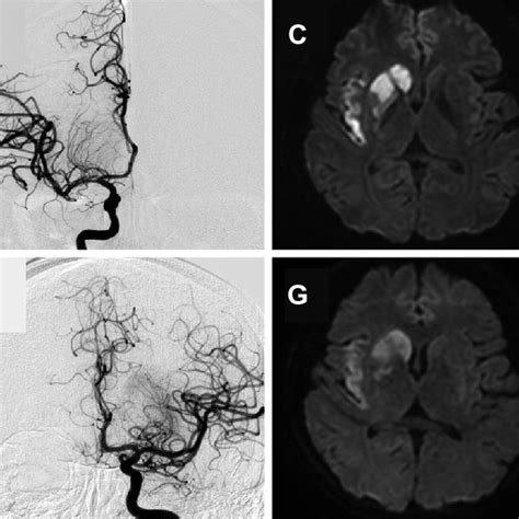 Digital Subtraction Angiography Dsa Brain Mri And Coronary Computed