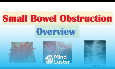 Learn Small Bowel Obstruction Sbo Risk Factors Causes Signs Symptoms