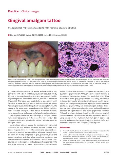 Pdf Gingival Amalgam Tattoo