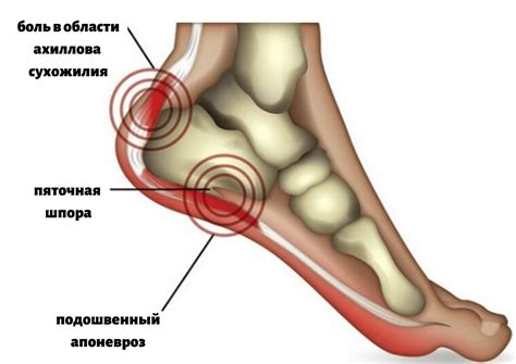 Пяточная шпора что это причины возникновения лечение и последствия