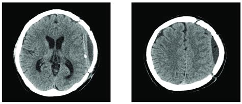 Brain Computed Tomography Scans At 8 Months After Cranioplasty Reveal Download Scientific