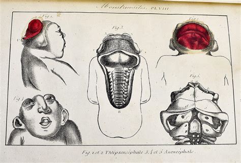 Histoire Generale Et Particuliere Des Anomalies De L Organisation Chez