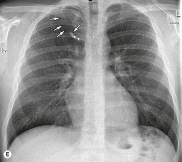 normal chest radiology key