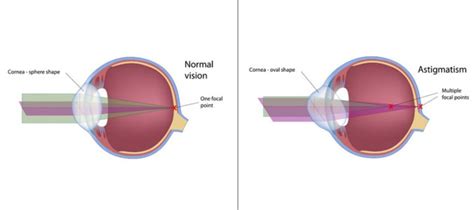 Astigmatism Symptoms And Care Casa Grande Eye Care