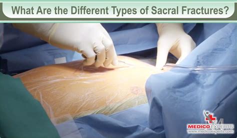 Sacral Fracture Treatment: Your Guide to Recovery