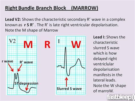 RBBB almost always has a pathological cause. Causes include: Ischaemic heart disease Pulmonary ...