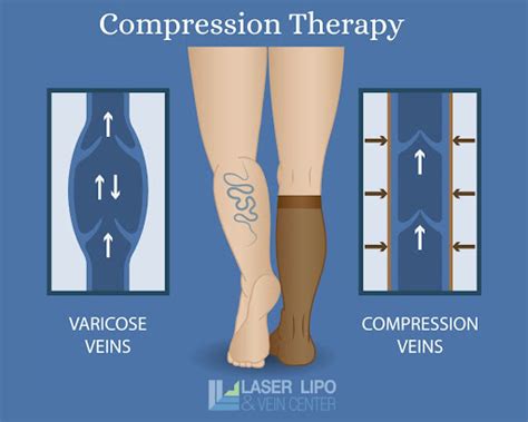 St Louis Arm And Leg Compression Stockings For Spider Veins Laser Lipo And Vein Center