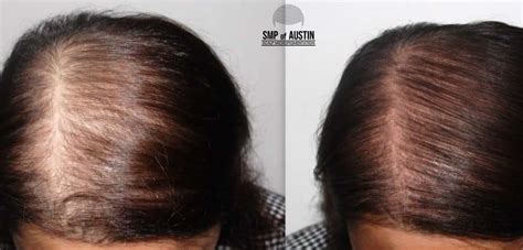 Top 3 Benefits Of Scalp Micropigmentation For Women Smp Of Austin