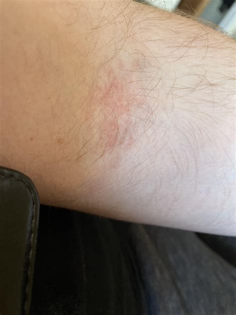 Rash Appeared A Week Ago On My Inner Elbow Crease It’s Itchy And E45 Hasn’t Really Been Helping