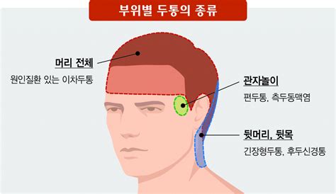 김태열 기자의 생생건강 갑작스럽게 깨질듯이 아픈 두통 아픈 부위별로 ‘질환도 달라 헤럴드경제