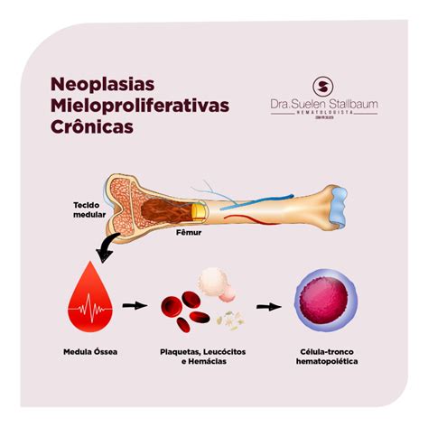 Neoplasias Mieloproliferativas Cr Nicas Nmpc Voc J Ouviu Falar