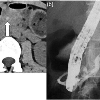 (a) Yogi et al. described six types of annular pancreas according to ...