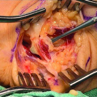 Intraoperative Photograph Of Right Elbow Depicting An Anomalous