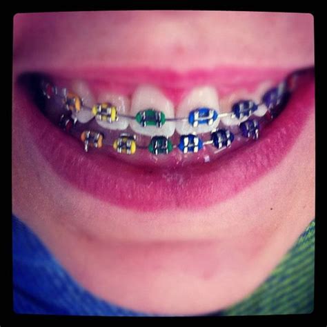 Cool Colors For Braces Teeth Braces Ideas Braces Colors Getting