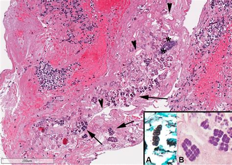 Scielo Brasil Emphysematous Gastritis Due To Sarcina Ventriculi