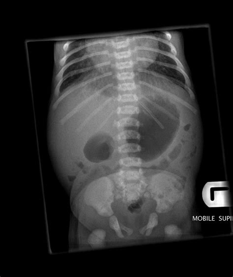 Duodenal Atresia X Ray