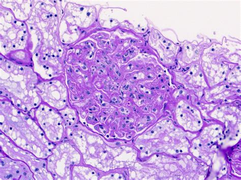 Membranoproliferative Glomerulonephritis Showing Mesangial Expansion Download Scientific