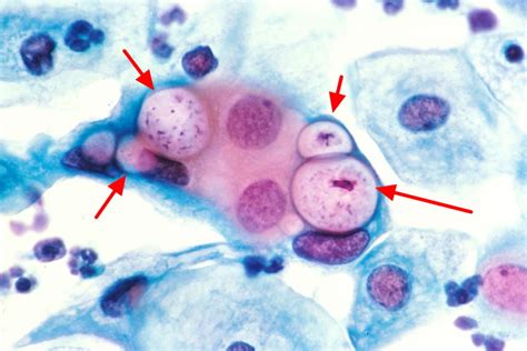 Chlamydia Trachomatis Gram Stain Morphology