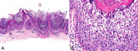 Epidermolytic Acanthoma