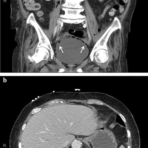 Computed Tomography Of The Abdomen And Pelvis Demonstrating Gas Within