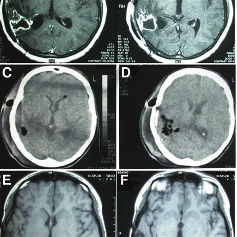 Case 35 Images Obtained In An 18 Year Old Man With A Postneurosurgical