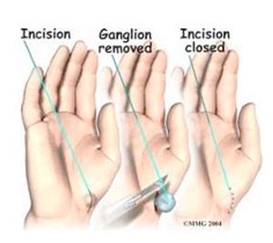 wrist ganglion london wrist pain london repetitive stress injuries
