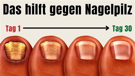 Überzeugende Hausmittel gegen Nagelpilz YouTube