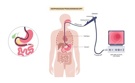 Premium Vector Esophagogastroduodenoscopy Medical Poster Diagnostic